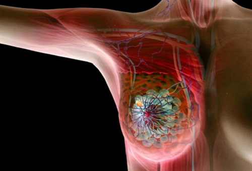 مزيلات العرق تزيد خطر سرطان الثدي